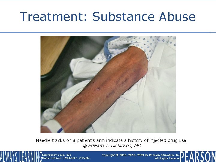 Treatment: Substance Abuse Needle tracks on a patient’s arm indicate a history of injected