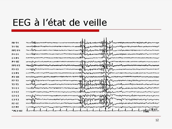 EEG à l’état de veille F 8 -T 4 T 4 -T 6 FP