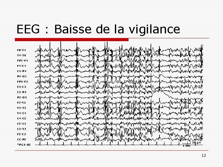 EEG : Baisse de la vigilance F 8 -T 4 T 4 -T 6