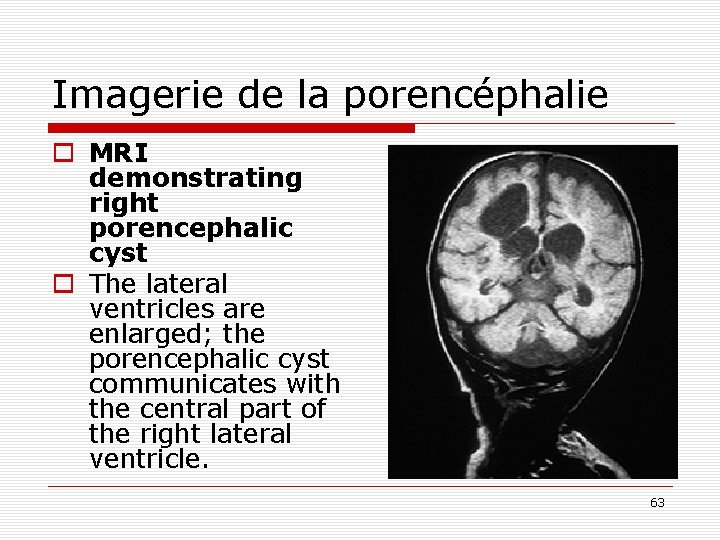 Imagerie de la porencéphalie o MRI demonstrating right porencephalic cyst o The lateral ventricles