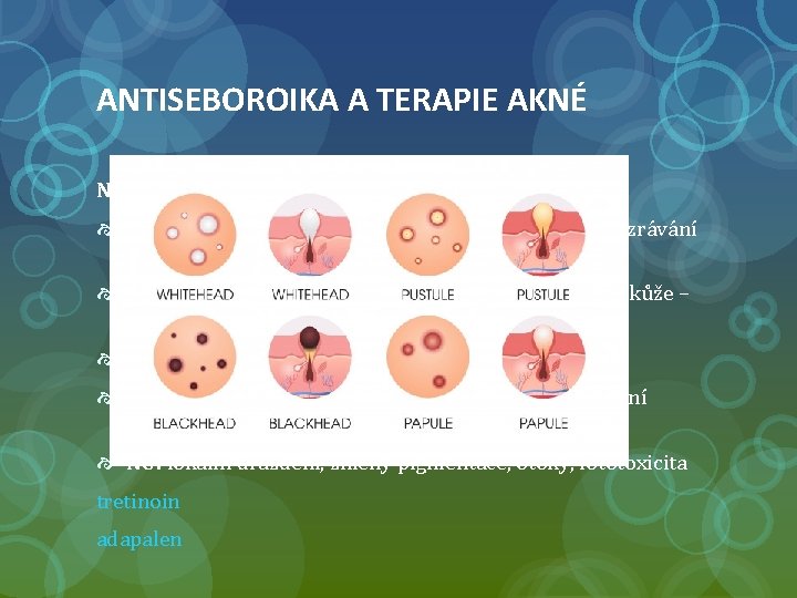 ANTISEBOROIKA A TERAPIE AKNÉ Nearomatické retinoidy a jejich analoga zmenšují velikost mazových žláz a