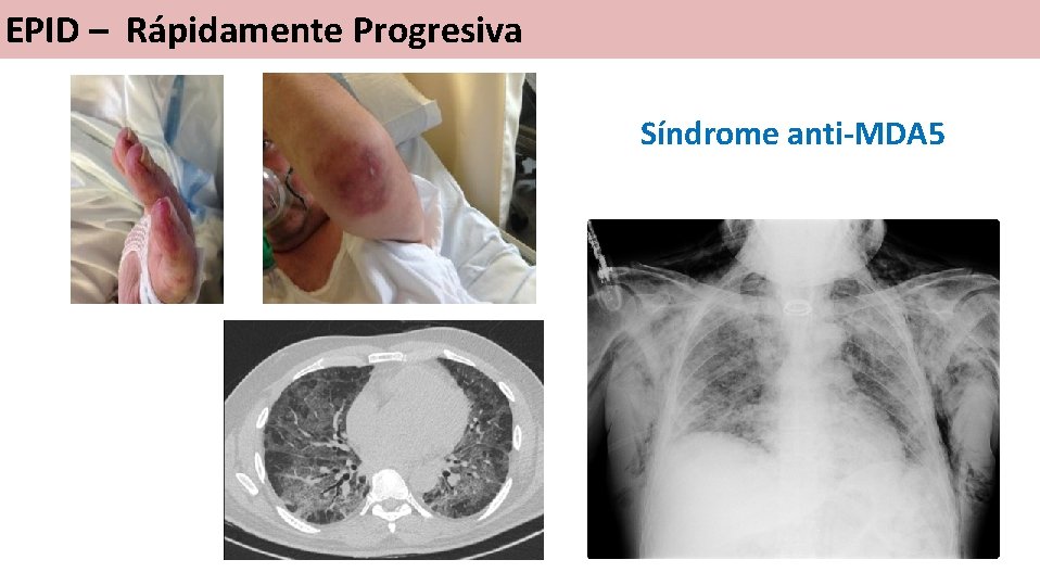 EPID – Rápidamente Progresiva Síndrome anti-MDA 5 