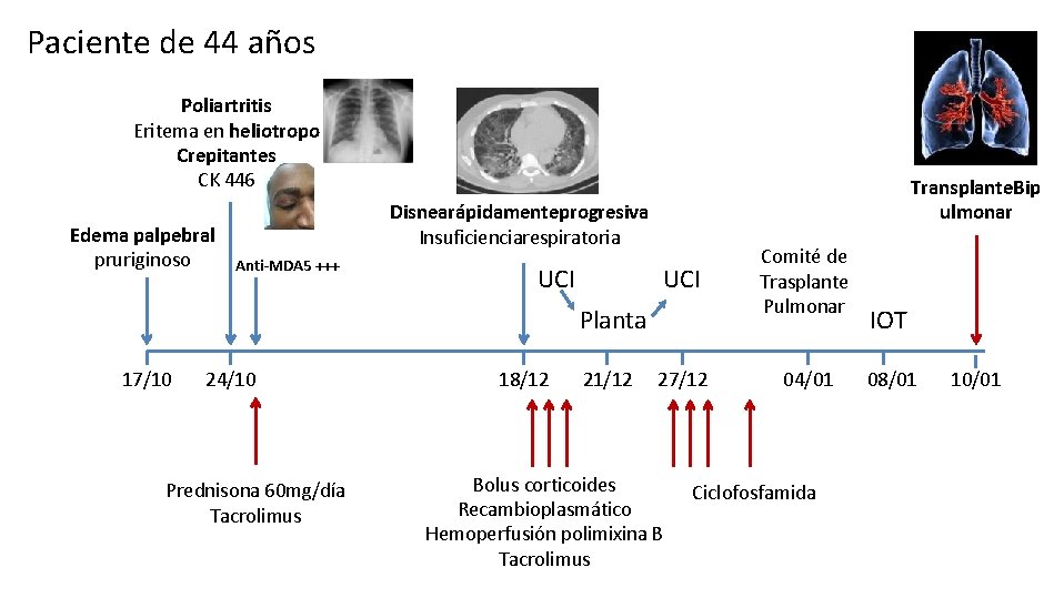 Paciente de 44 años Poliartritis Eritema en heliotropo Crepitantes CK 446 Edema palpebral pruriginoso