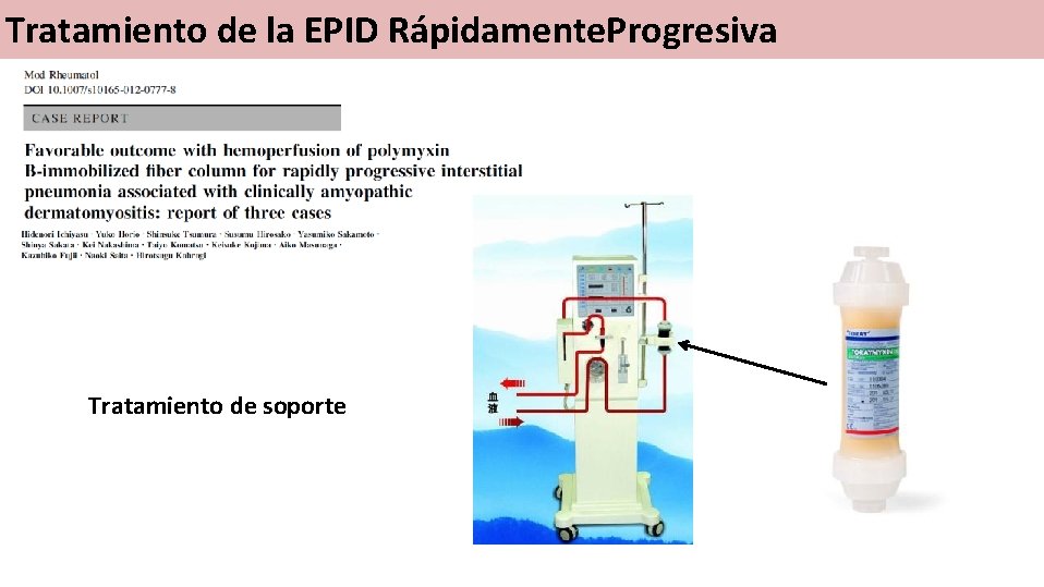 Síndrome asociadode a anticuerpos Tratamiento la EPIDanti-MDA 5 Rápidamente. Progresiva Tratamiento de soporte 