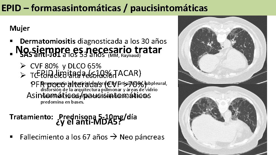 EPID – formasasintomáticas / paucisintomáticas Mujer § Dermatomiositis diagnosticada a los 30 años es