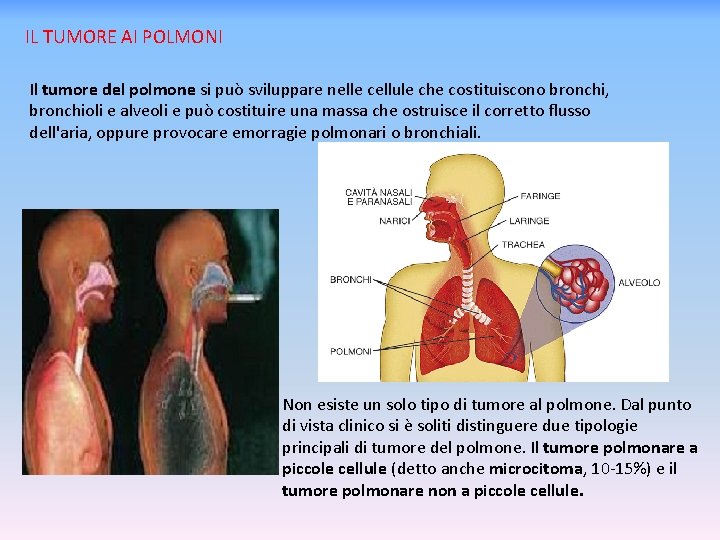 IL TUMORE AI POLMONI Il tumore del polmone si può sviluppare nelle cellule che