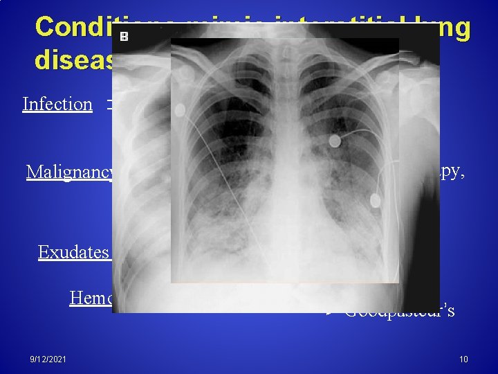 Conditions mimic interstitial lung disease Viral Pneumonia Pneumocystis Pneumonia Infection Malignancy Leukemia, Lymphoma, Radiotherapy,