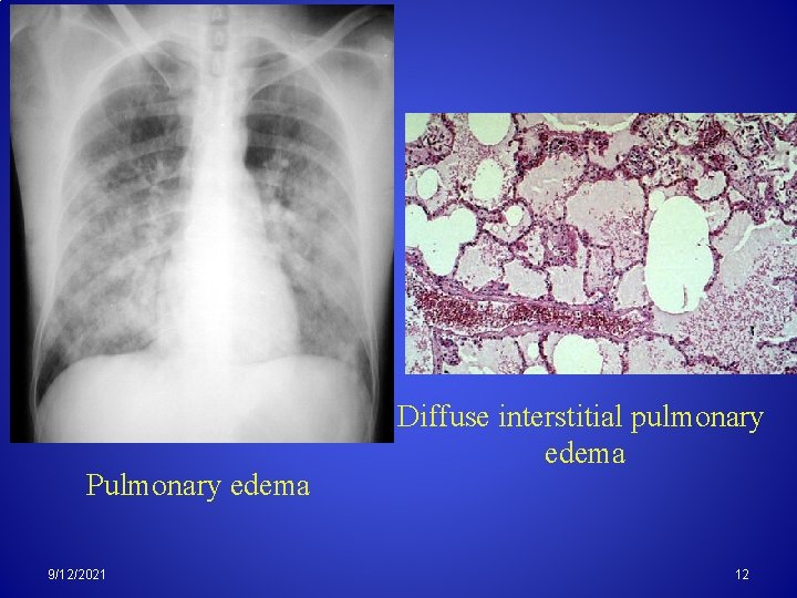 Pulmonary edema 9/12/2021 Diffuse interstitial pulmonary edema 12 