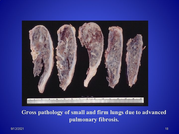 Gross pathology of small and firm lungs due to advanced pulmonary fibrosis. 9/12/2021 18