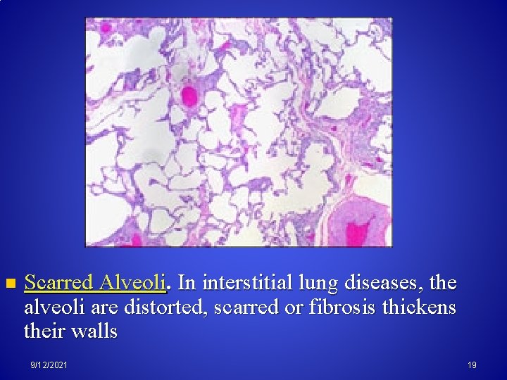 n Scarred Alveoli. In interstitial lung diseases, the alveoli are distorted, scarred or fibrosis