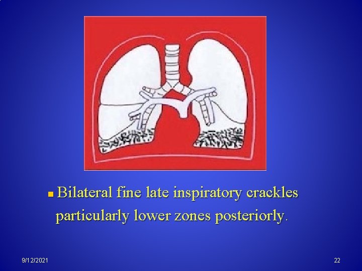 n 9/12/2021 Bilateral fine late inspiratory crackles particularly lower zones posteriorly. 22 