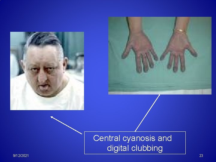 Central cyanosis and digital clubbing 9/12/2021 23 