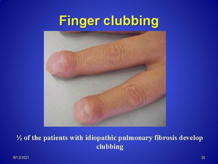Finger clubbing ½ of the patients with idiopathic pulmonary fibrosis develop clubbing 9/12/2021 24