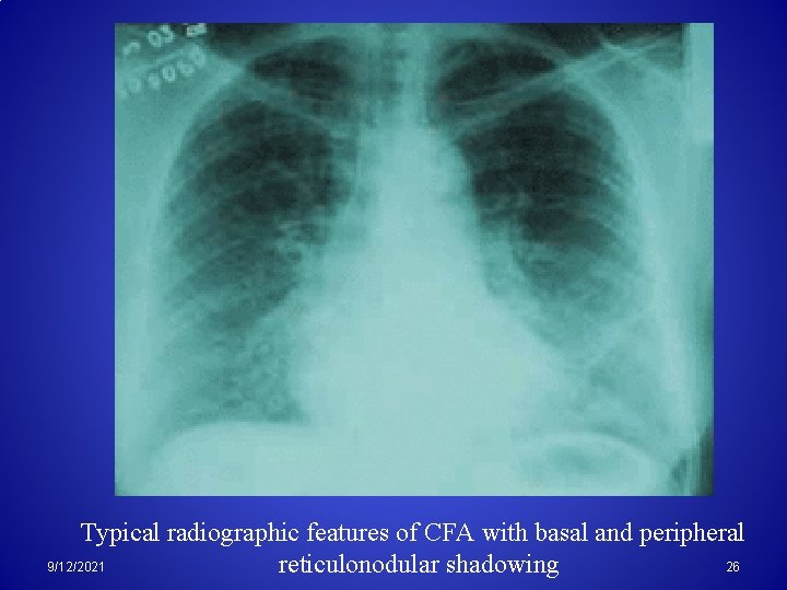 Typical radiographic features of CFA with basal and peripheral 26 9/12/2021 reticulonodular shadowing 