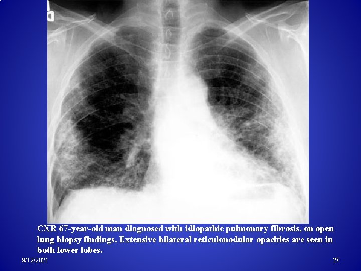 CXR 67 -year-old man diagnosed with idiopathic pulmonary fibrosis, on open lung biopsy findings.