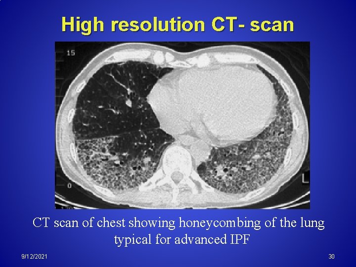 High resolution CT- scan CT scan of chest showing honeycombing of the lung typical