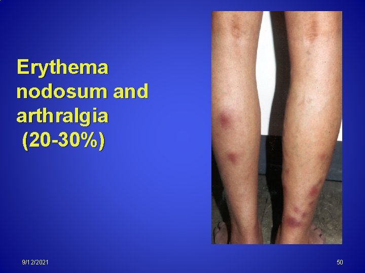 Erythema nodosum and arthralgia (20 -30%) 9/12/2021 50 