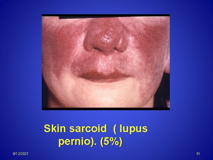 Skin sarcoid ( lupus pernio). (5%) 9/12/2021 51 