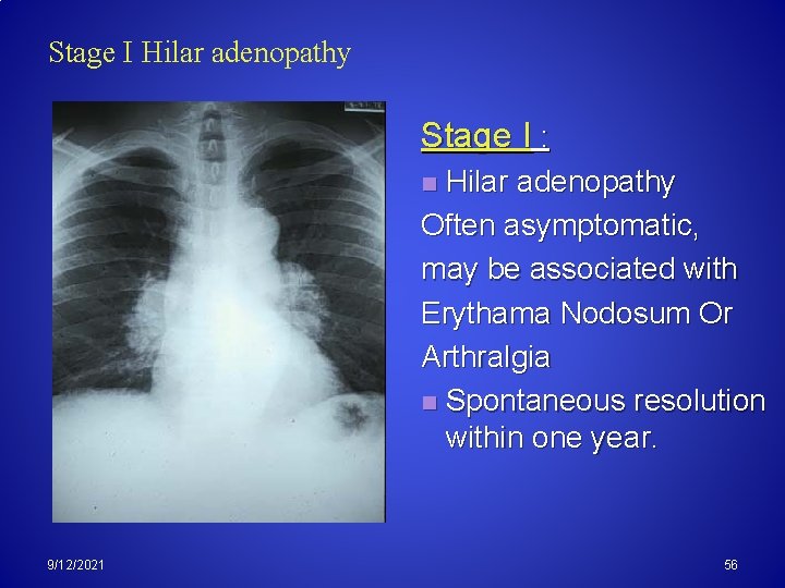 Stage I Hilar adenopathy Stage I : Hilar adenopathy Often asymptomatic, may be associated