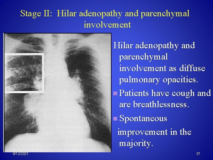 Stage II: Hilar adenopathy and parenchymal involvement as diffuse pulmonary opacities. n Patients have