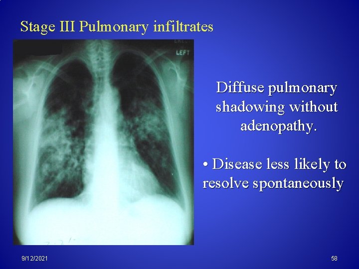 Stage III Pulmonary infiltrates Diffuse pulmonary shadowing without adenopathy. • Disease less likely to