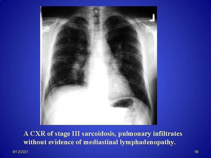 A CXR of stage III sarcoidosis, pulmonary infiltrates without evidence of mediastinal lymphadenopathy. 9/12/2021