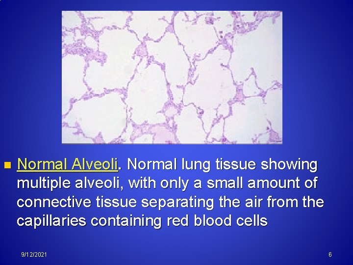 n Normal Alveoli. Normal lung tissue showing multiple alveoli, with only a small amount