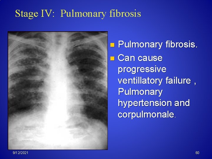 Stage IV: Pulmonary fibrosis. n Can cause progressive ventillatory failure , Pulmonary hypertension and