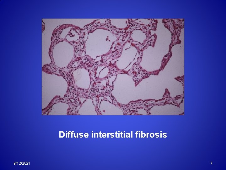 Diffuse interstitial fibrosis 9/12/2021 7 