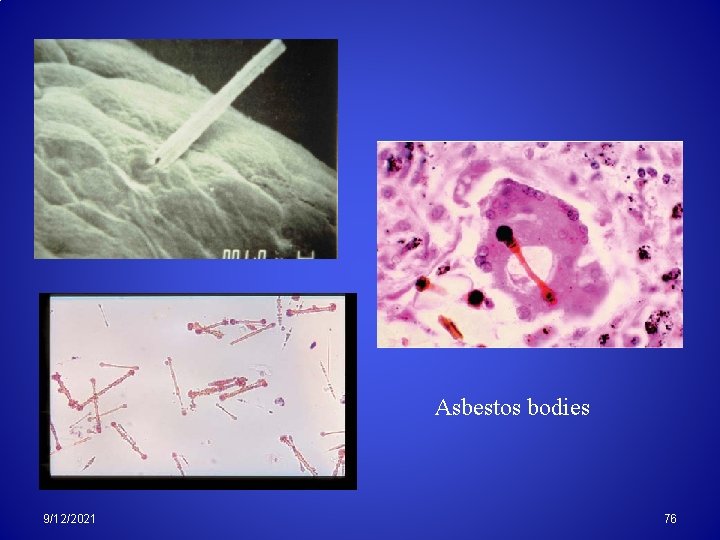 Asbestos bodies 9/12/2021 76 