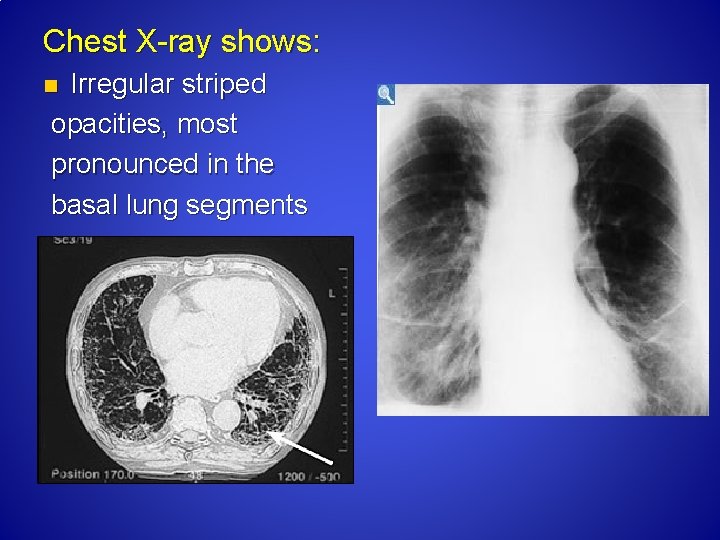 Chest X ray shows: Irregular striped opacities, most pronounced in the basal lung segments