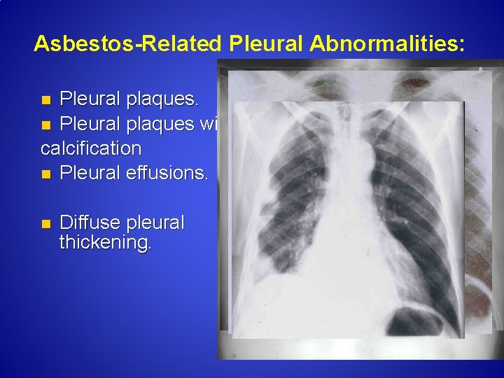 Asbestos-Related Pleural Abnormalities: Pleural plaques. n Pleural plaques with calcification n Pleural effusions. n