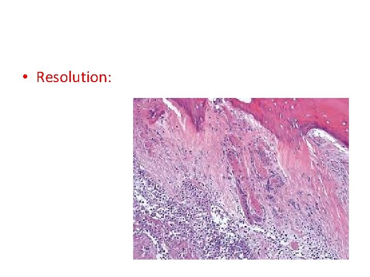 Bone infection Dr Sami Abdalla Definition An inflammation