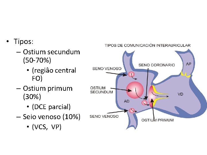  • Tipos: – Ostium secundum (50 -70%) • (regiâo central FO) – Ostium