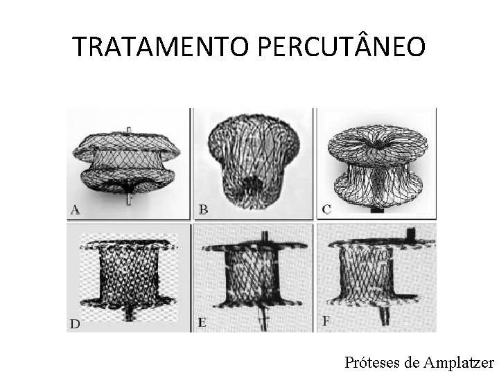 TRATAMENTO PERCUT NEO Próteses de Amplatzer 