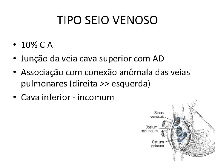 TIPO SEIO VENOSO • 10% CIA • Junção da veia cava superior com AD