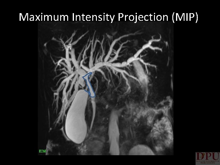 Maximum Intensity Projection (MIP) 