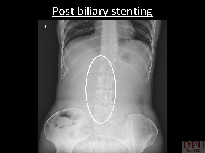 Post biliary stenting 