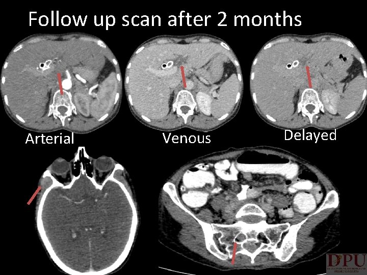 Follow up scan after 2 months Arterial Venous Delayed 