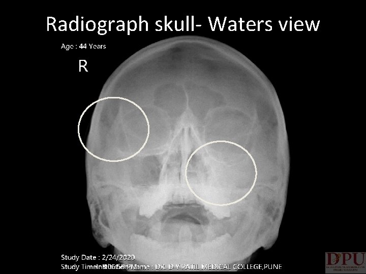Radiograph skull- Waters view 