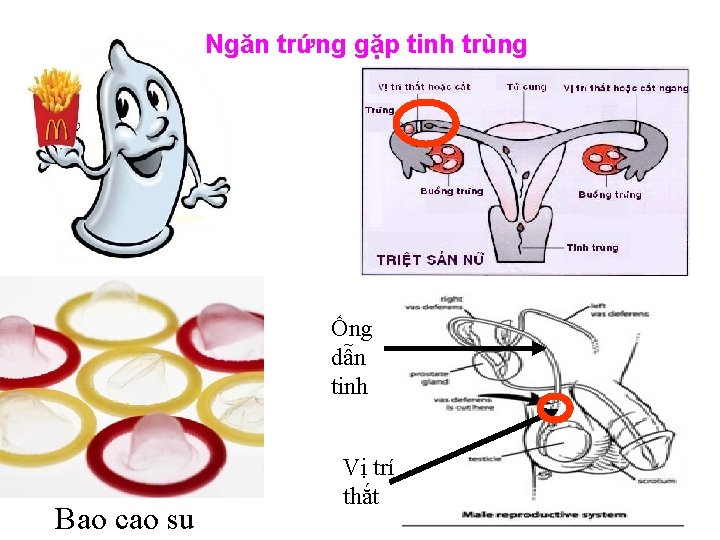 Ngăn trứng gặp tinh trùng Ống dẫn tinh Bao cao su Vị trí thắt