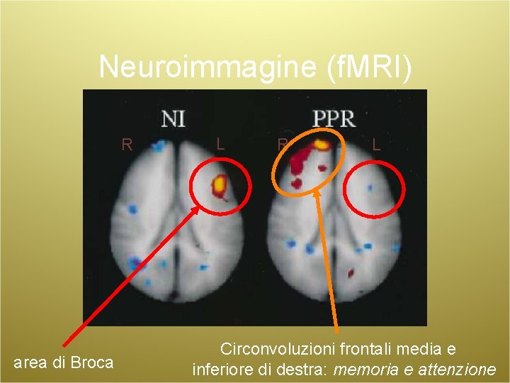 Neuroimmagine (f. MRI) R area di Broca L R L Circonvoluzioni frontali media e