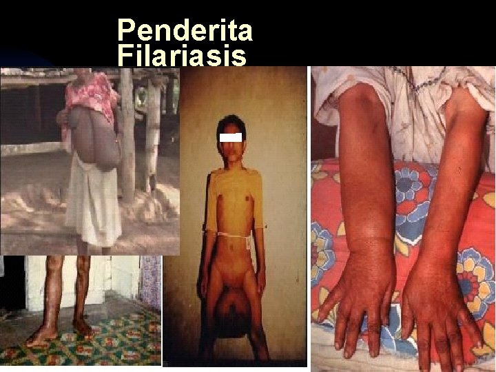 Penderita Filariasis 