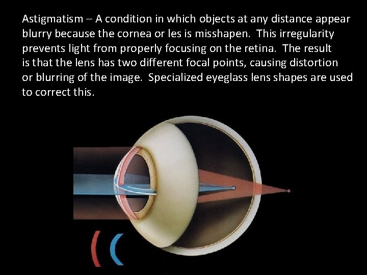 Astigmatism – A condition in which objects at any distance appear blurry because the