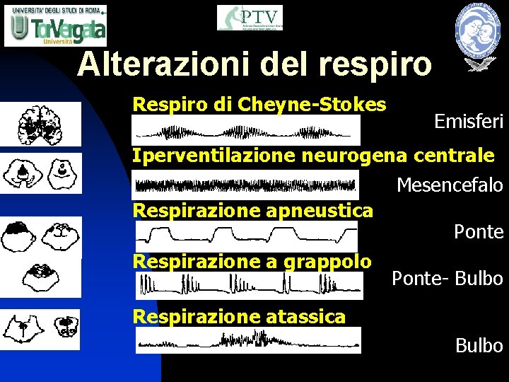 Alterazioni del respiro Respiro di Cheyne-Stokes Emisferi Iperventilazione neurogena centrale Mesencefalo Respirazione apneustica Ponte