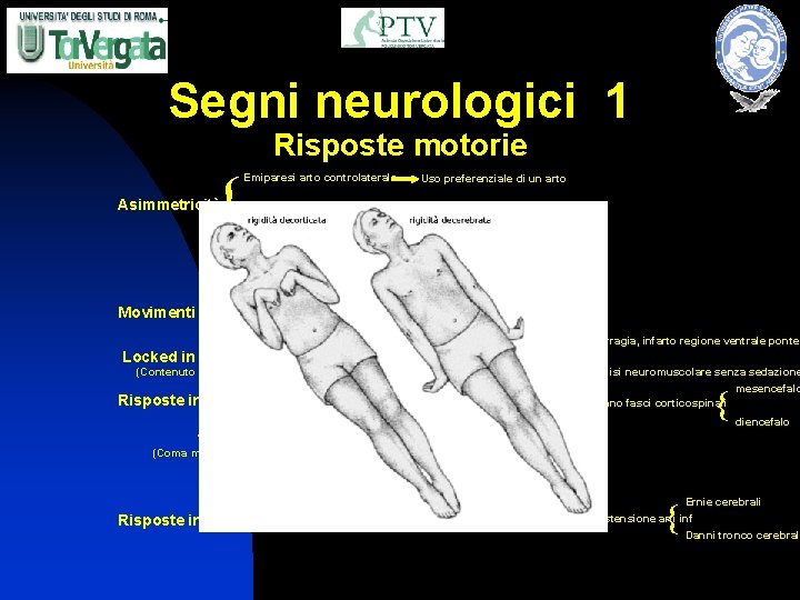 Segni neurologici 1 Risposte motorie { Emiparesi arto controlaterale Asimmetricità Uso preferenziale di un
