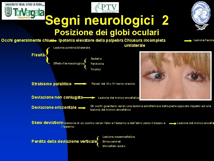 Segni neurologici 2 Posizione dei globi oculari Ipotonia elevatore della palpebra Chiusura incompleta unilaterale