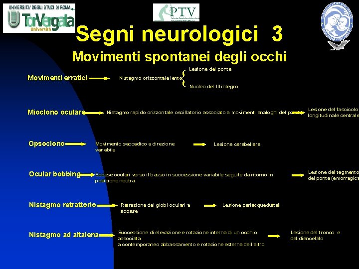 Segni neurologici 3 Movimenti spontanei degli occhi { Movimenti erratici Lesione del ponte Nistagmo