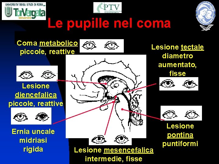 Le pupille nel coma Coma metabolico piccole, reattive Lesione tectale diametro aumentato, fisse Lesione