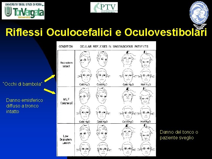 Riflessi Oculocefalici e Oculovestibolari “Occhi di bambola” Danno emisferico diffuso a tronco intatto Danno